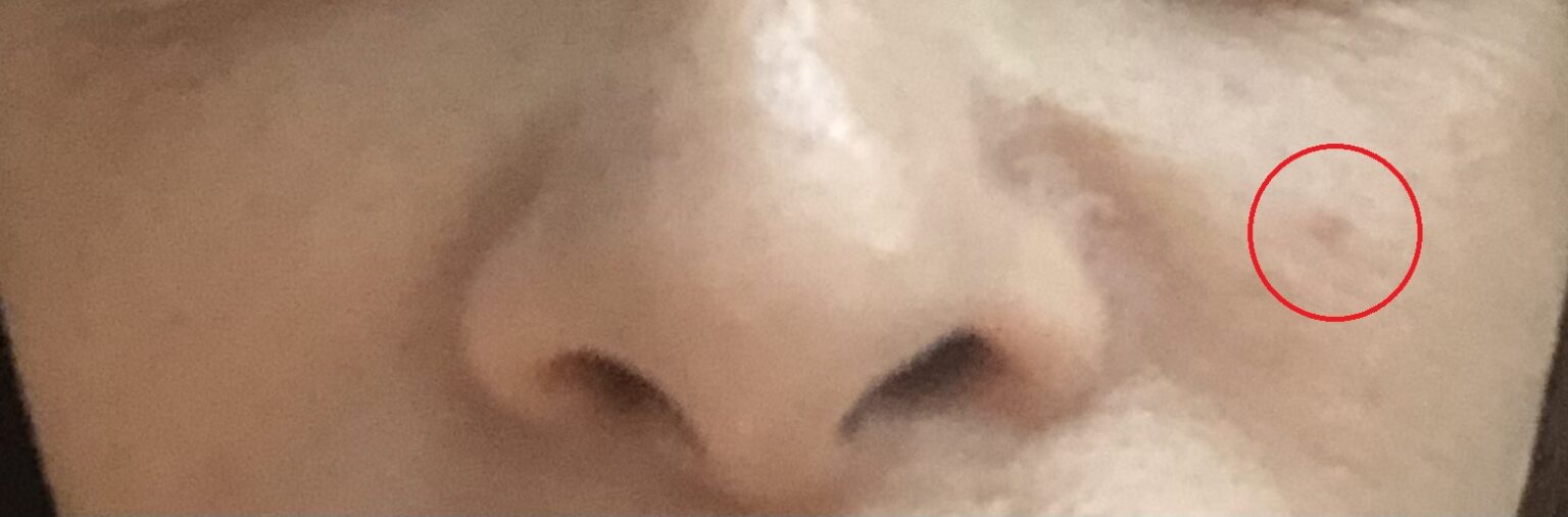 Close-up of a cherry spot circled in red beside the nose