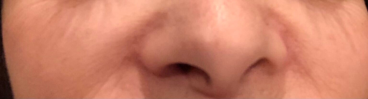 Close-up of nose and cheek skin before treatment